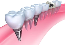 Tooth Implant CAD Model